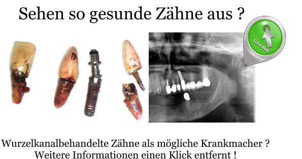 Wurzelkanalbehandelte Zähne als mögliche Krankmacher ? Weitere Informationen einen Klick entfernt ! Sehen so gesunde Zähne aus ?
