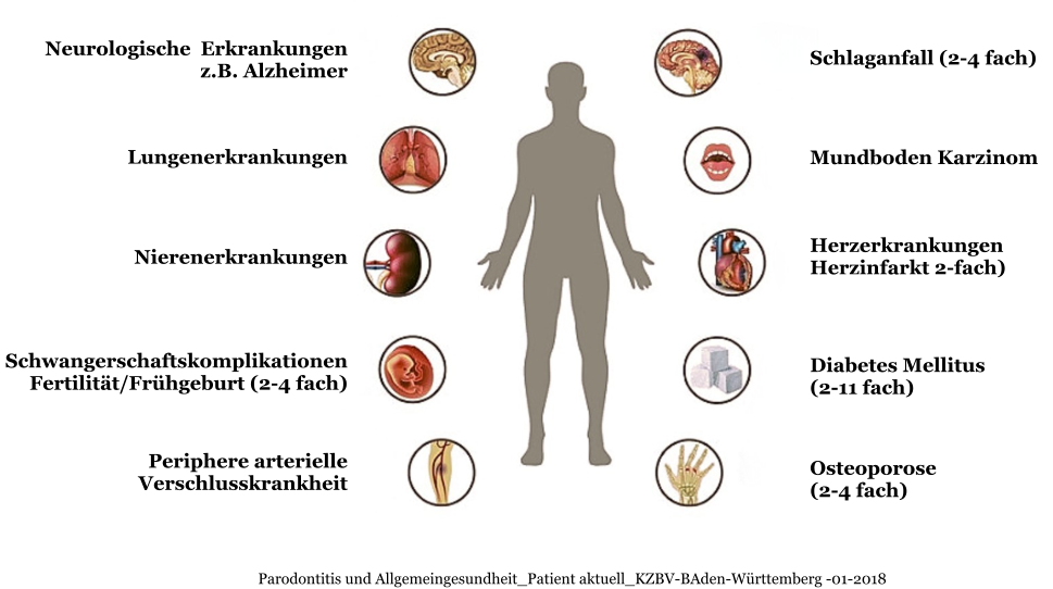 Osteoporose (2-4 fach) Mundboden Karzinom Schlaganfall (2-4 fach) Herzerkrankungen Herzinfarkt 2-fach) Diabetes Mellitus  (2-11 fach) Neurologische  Erkrankungen z.B. Alzheimer Lungenerkrankungen Nierenerkrankungen Schwangerschaftskomplikationen Fertilität/Frühgeburt (2-4 fach)  Periphere arterielle Verschlusskrankheit Parodontitis und Allgemeingesundheit_Patient aktuell_KZBV-BAden-Württemberg -01-2018