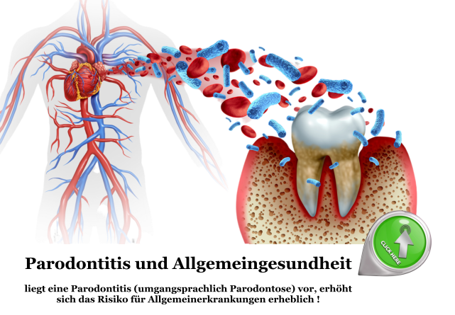 Parodontitis und Allgemeingesundheit  liegt eine Parodontitis (umgangsprachlich Parodontose) vor, erhöht sich das Risiko für Allgemeinerkrankungen erheblich !
