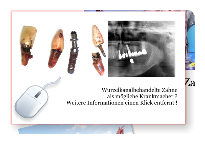 Wurzelkanalbehandelte Zähne  als mögliche Krankmacher ? Weitere Informationen einen Klick entfernt !