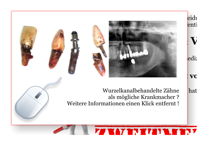 Wurzelkanalbehandelte Zähne  als mögliche Krankmacher ? Weitere Informationen einen Klick entfernt !