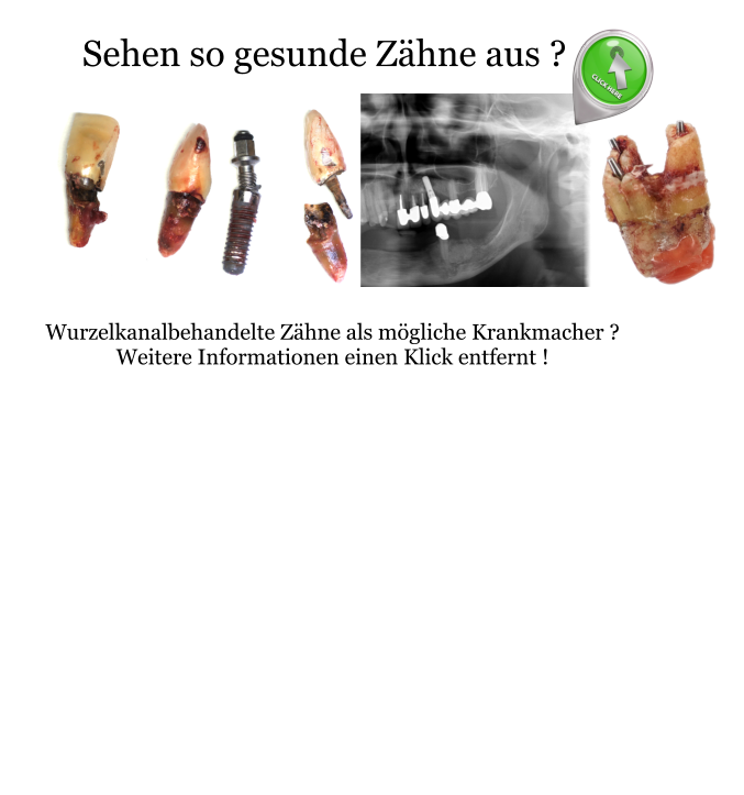 Wurzelkanalbehandelte Zähne als mögliche Krankmacher ? Weitere Informationen einen Klick entfernt ! Sehen so gesunde Zähne aus ?