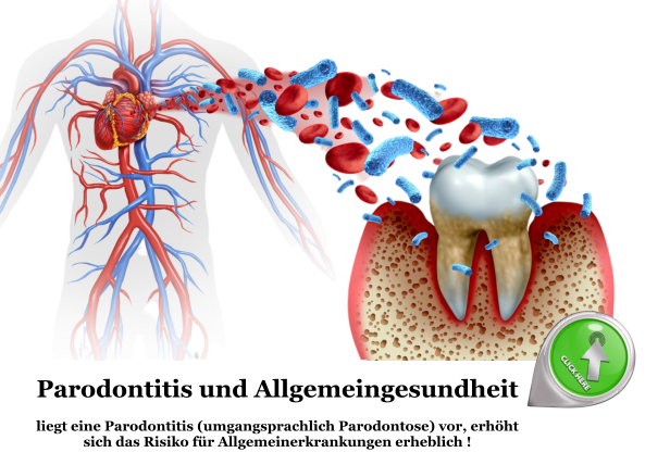 parodontitis und allgemeingesundheit